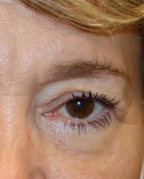 Lower Blepharoplasty before and after - after