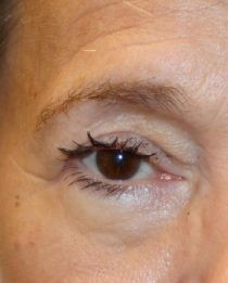 Lower Blepharoplasty before and after - before
