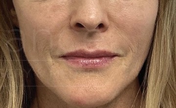 Procedure before and after - after