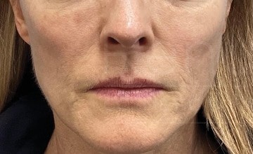Procedure before and after - before