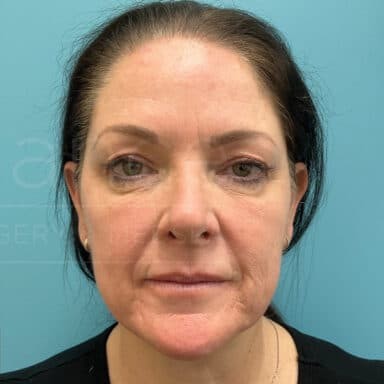 Procedure before and after - after