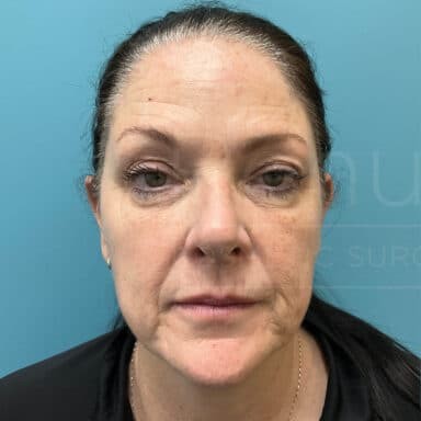 Procedure before and after - before