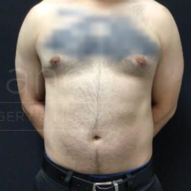 Procedure before and after - after