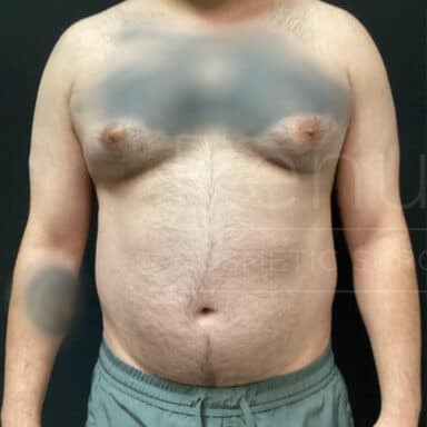 Procedure before and after - before
