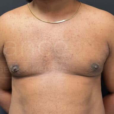 Procedure before and after - after