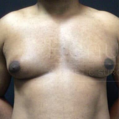 Procedure before and after - before