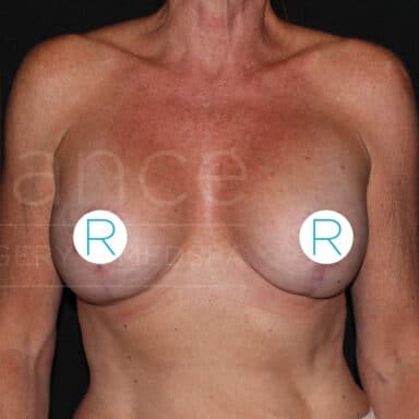 Procedure before and after - after