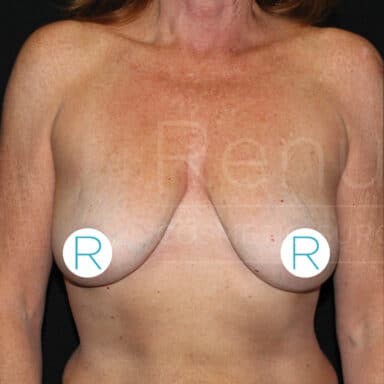 Procedure before and after - before