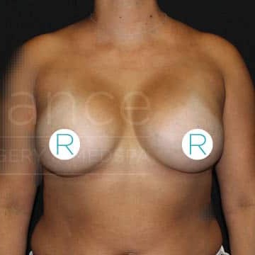 Procedure before and after - after