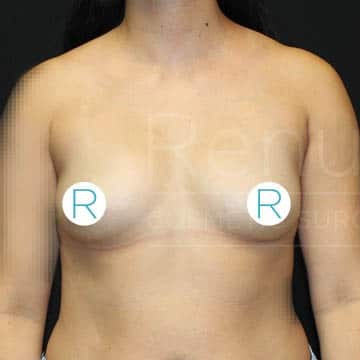 Procedure before and after - before
