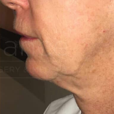 Procedure before and after - after