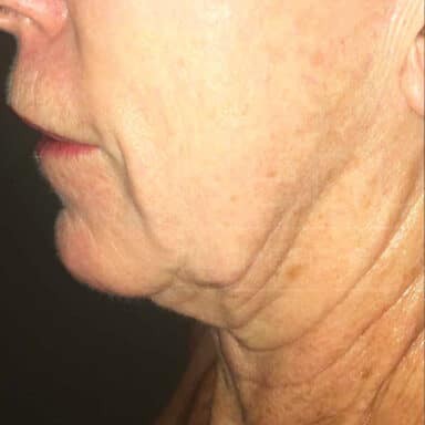 Procedure before and after - before