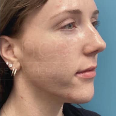 Procedure before and after - after