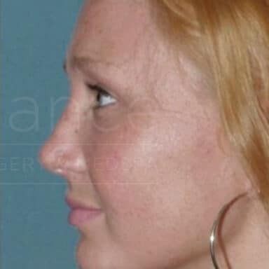 Procedure before and after - after