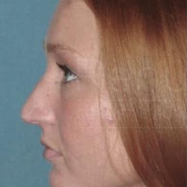Procedure before and after - before