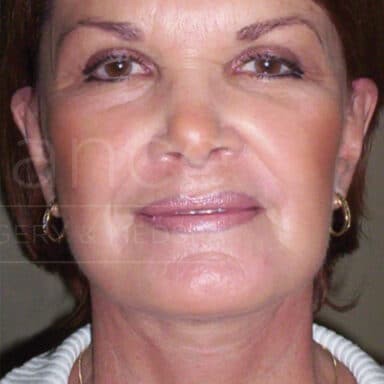 Procedure before and after - after