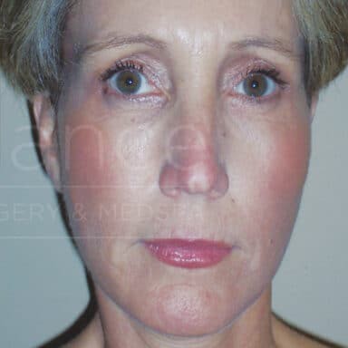 Procedure before and after - after