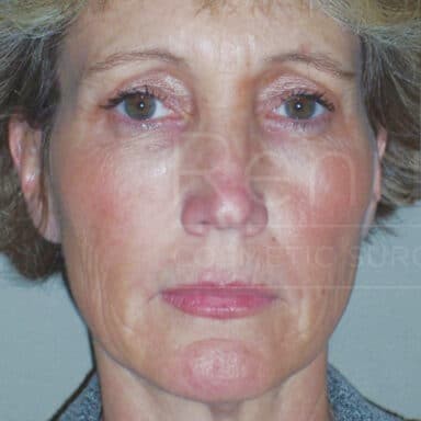 Procedure before and after - before