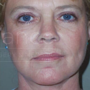 Procedure before and after - after