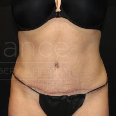 Procedure before and after - after