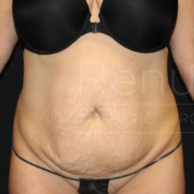 Procedure before and after - before