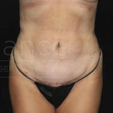 Procedure before and after - after