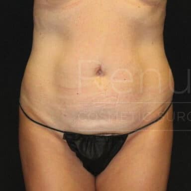 Procedure before and after - before