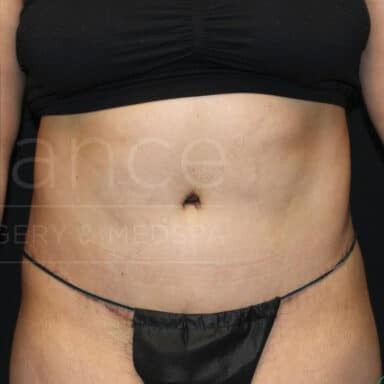 Procedure before and after - after