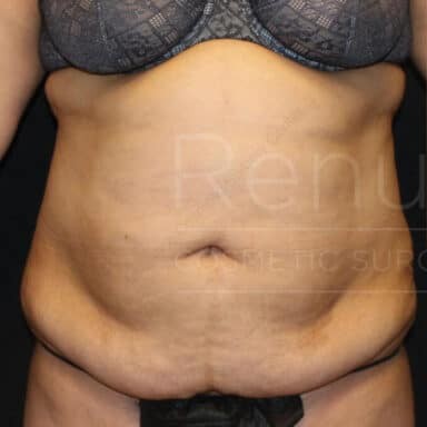 Procedure before and after - before