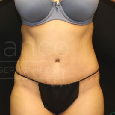 Procedure before and after - after