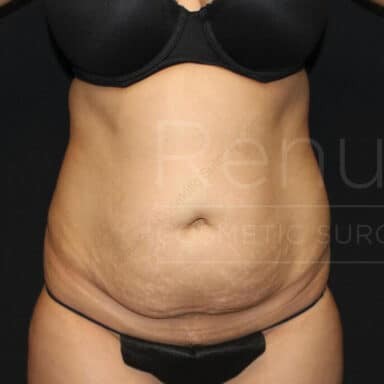 Procedure before and after - before