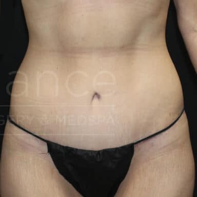 Procedure before and after - after