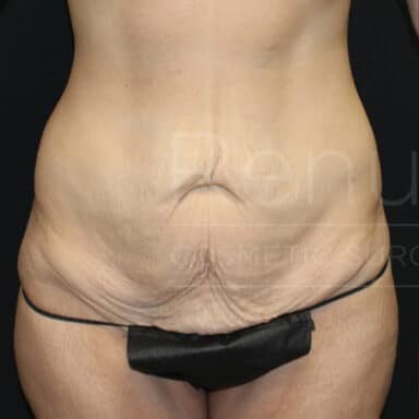 Procedure before and after - before