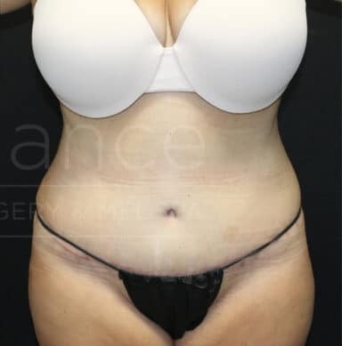 Procedure before and after - after