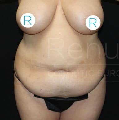 Procedure before and after - before