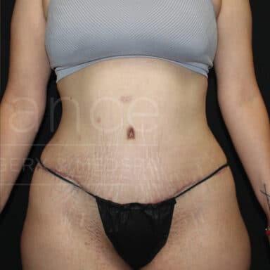 Procedure before and after - after