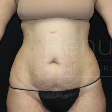 Procedure before and after - before