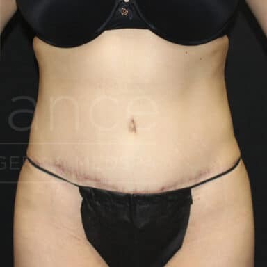 Procedure before and after - after