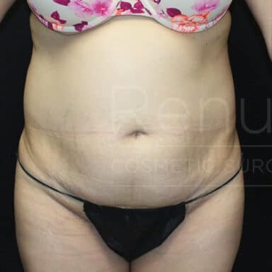 Procedure before and after - before