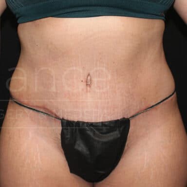 Procedure before and after - after