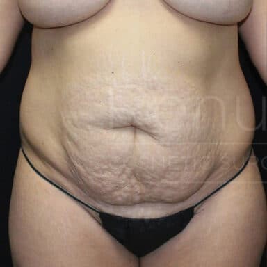 Procedure before and after - before