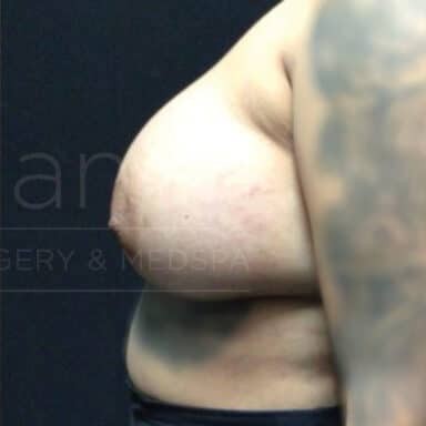 Procedure before and after - after