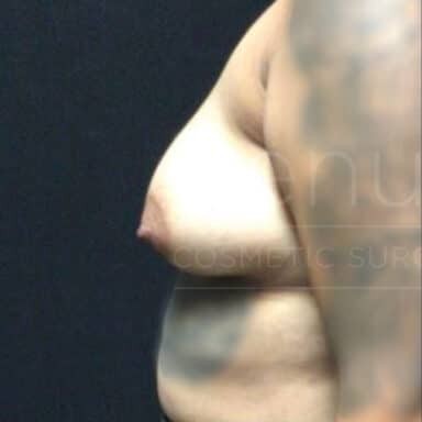 Procedure before and after - before