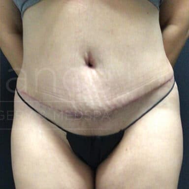 Procedure before and after - after