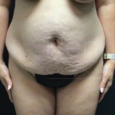 Procedure before and after - before