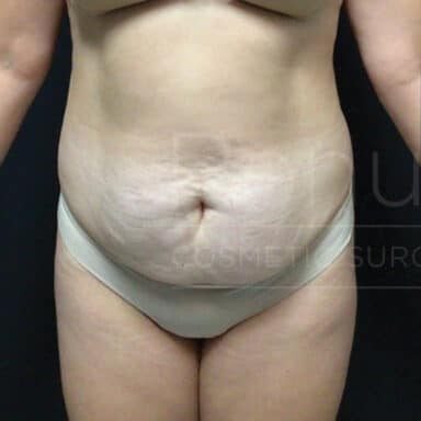 Procedure before and after - before