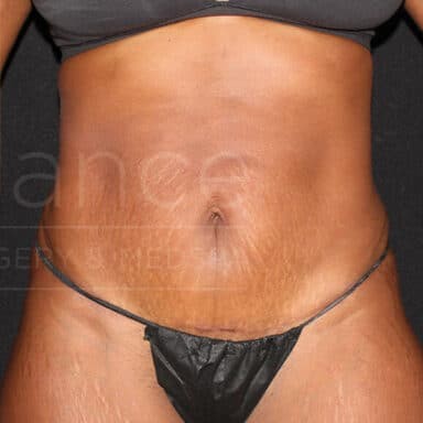 Procedure before and after - after