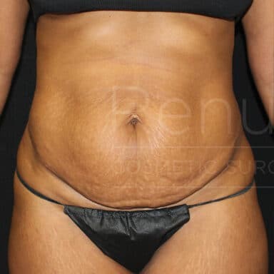 Procedure before and after - before