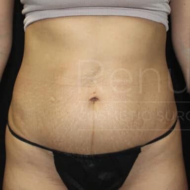 Procedure before and after - before