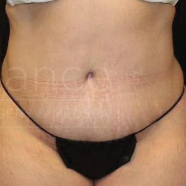 Procedure before and after - after